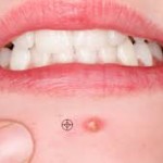desiherbal.com-pimple cure