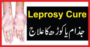 Leprosy cure جذام یا کوڑھ کا علاج