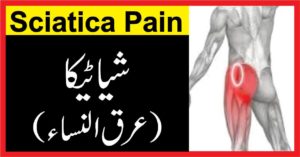 sciatica pain :(شیاٹیکا (عرق النساء