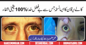 Hepatitis C Treatments(Kala YarqanKa Elaj) in Urdu