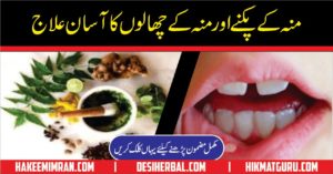 Moun Aur Zaban Ky Chale Ka ilaj Mouth And Tongue Blisters Cure (2)